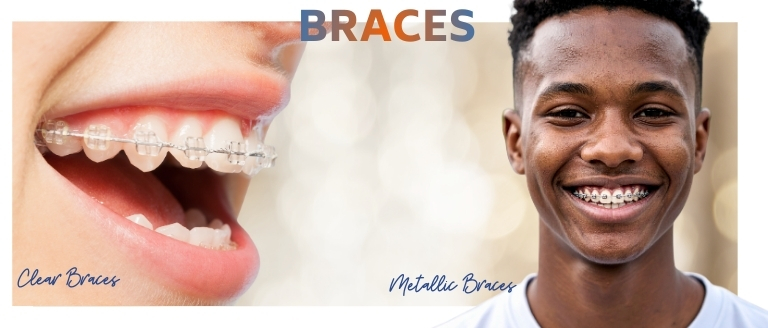 Clear and Metallic Braces