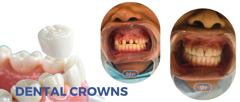 Dental Crowns at Unicorn Dental Clinic Nairobi
