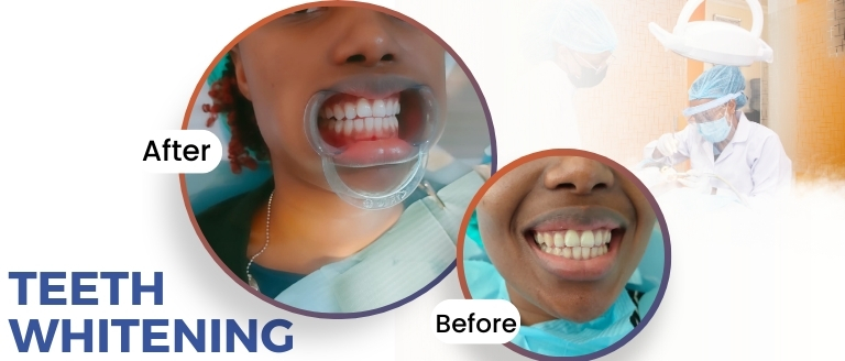 Teeth Whitening Langata dental and Utawala Dental