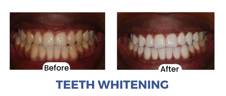 Teeth Whitening at Unicorn Dental Clinic Nairobi